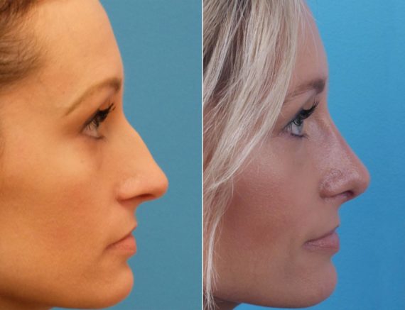 Large Nose Before and After Photos in Sewell, NJ