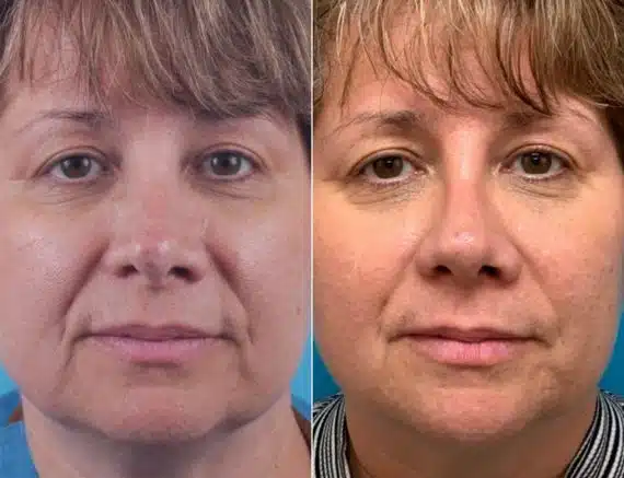 Twisted Nose Before and After Photos in Sewell, NJ, Patient 8540