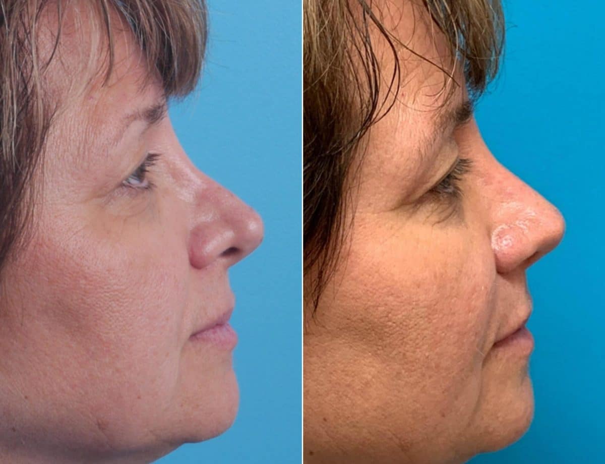 Twisted Nose Before and After Photos in Sewell, NJ, Patient 8540