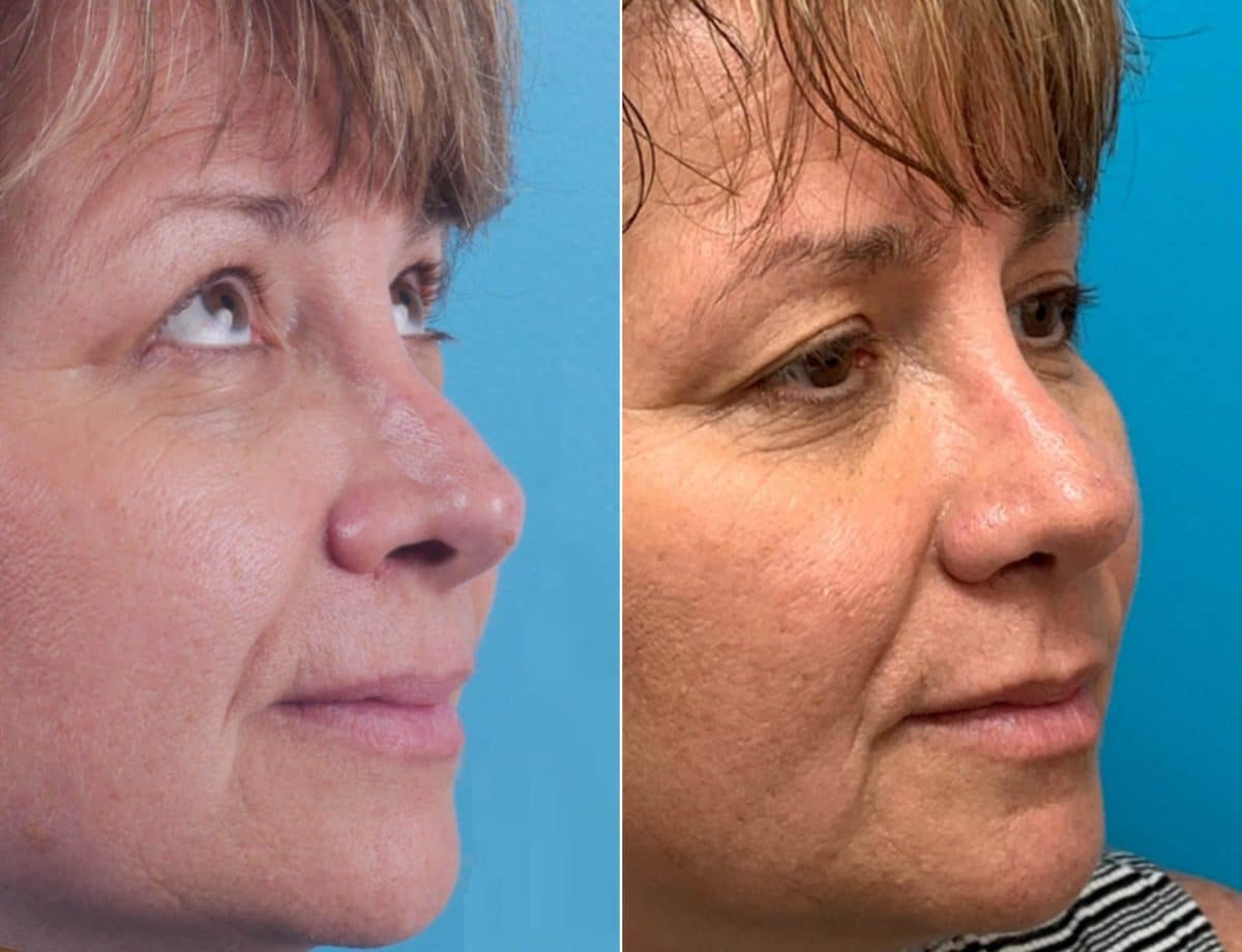 Twisted Nose Before and After Photos in Sewell, NJ, Patient 8540