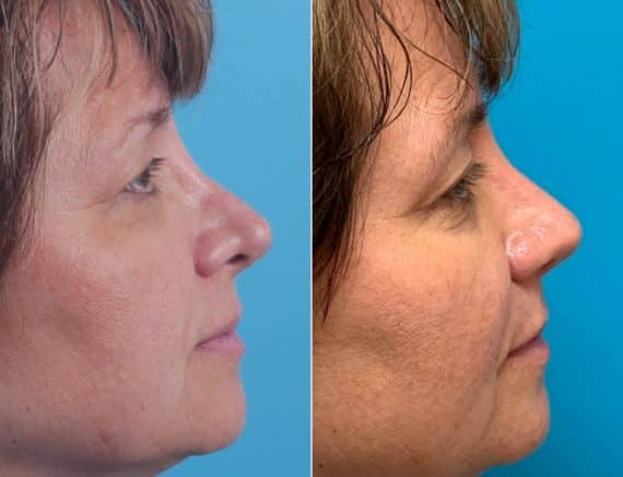 Twisted Nose Before and After Photos in Sewell, NJ, Patient 8540