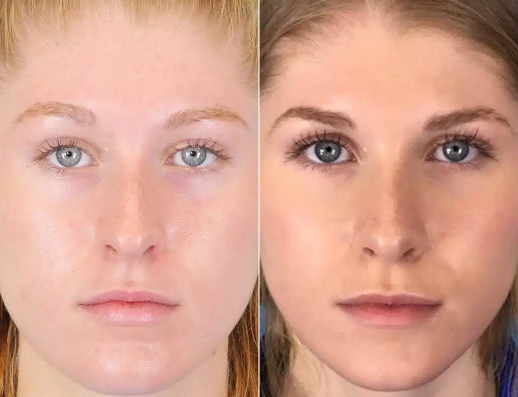 How Does Skin Thickness Affect Rhinoplasty? Dr. Daniel Becker