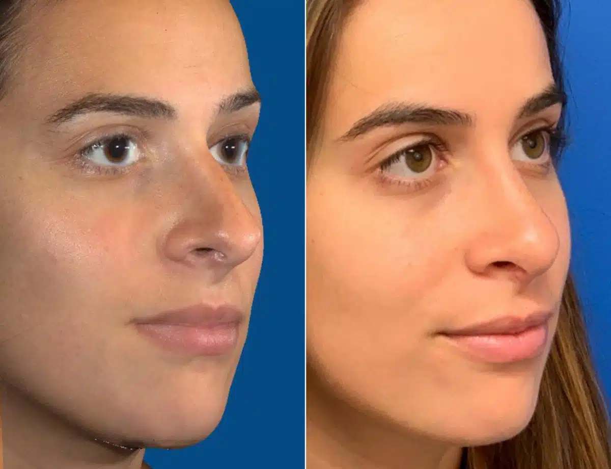 Nasal Bump Before and After Photos in Sewell, NJ, Patient 8441