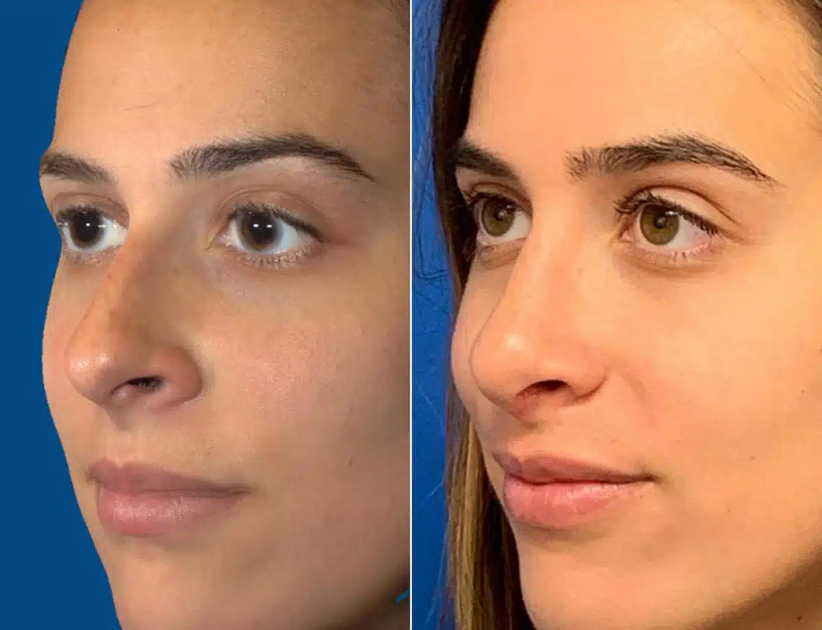 Nasal Bump Before and After Photos in Sewell, NJ, Patient 8441