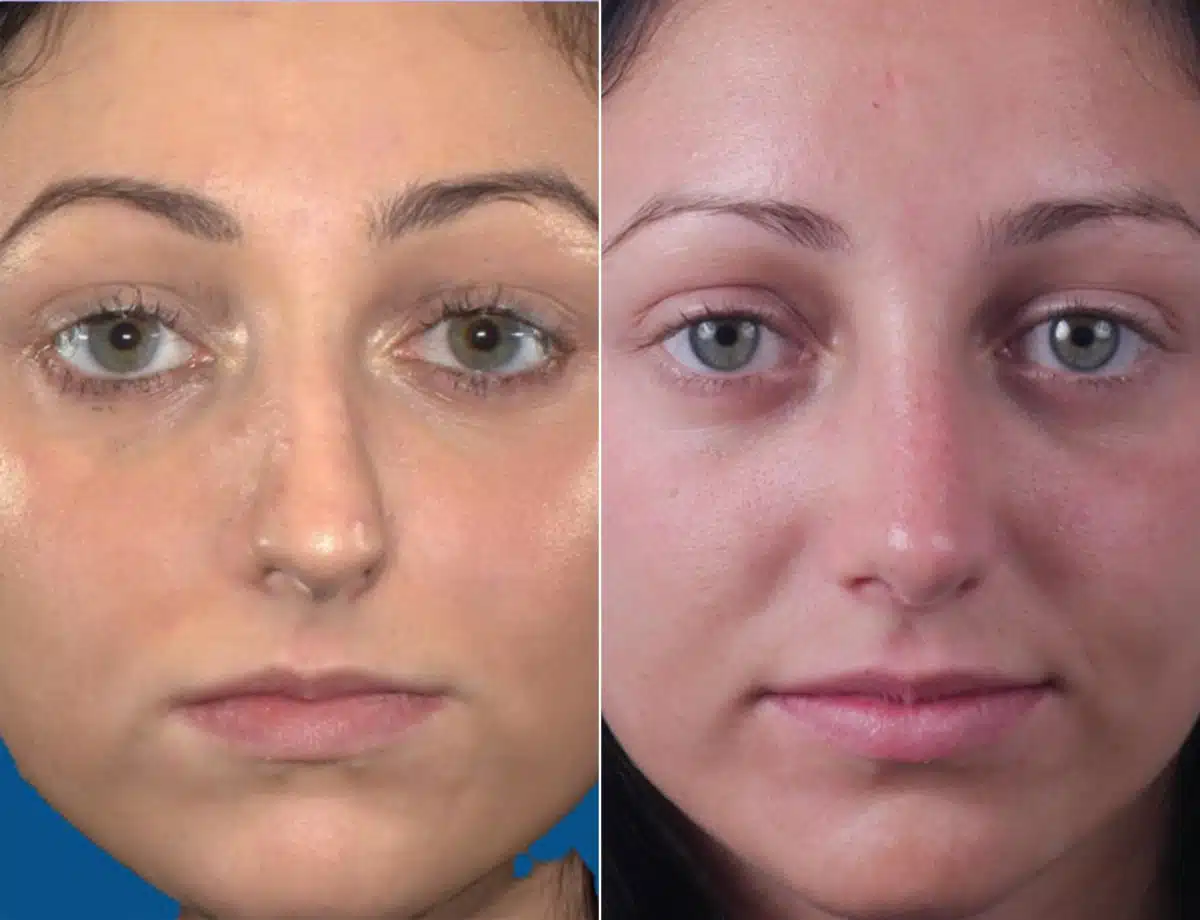 Nasal Bump Before and After Photos in Sewell, NJ, Patient 8442