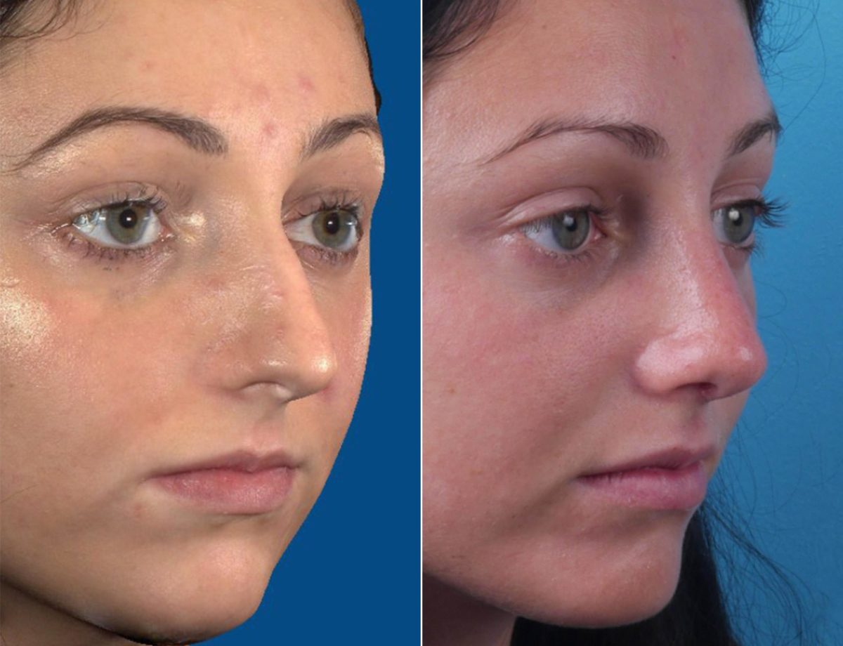 Nasal Bump Before and After Photos in Sewell, NJ, Patient 8442