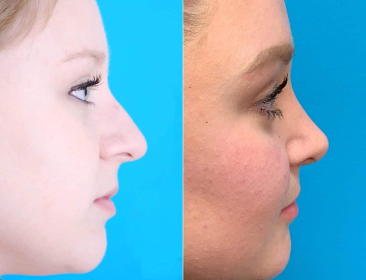 Nasal Bump Before and After Photos in Sewell, NJ, Patient 8443