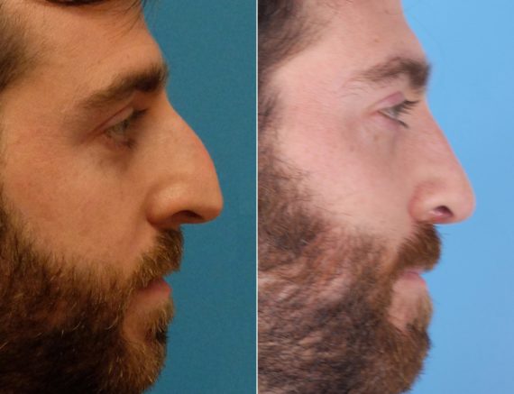 Nasal Bump Before and After Photos in Sewell, NJ, Patient 8445