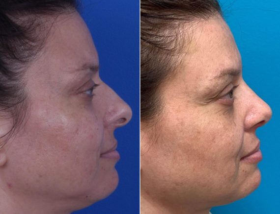 Nasal Bump Before and After Photos in Sewell, NJ, Patient 8532