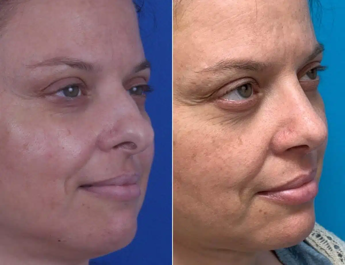 Nasal Bump Before and After Photos in Sewell, NJ, Patient 8532