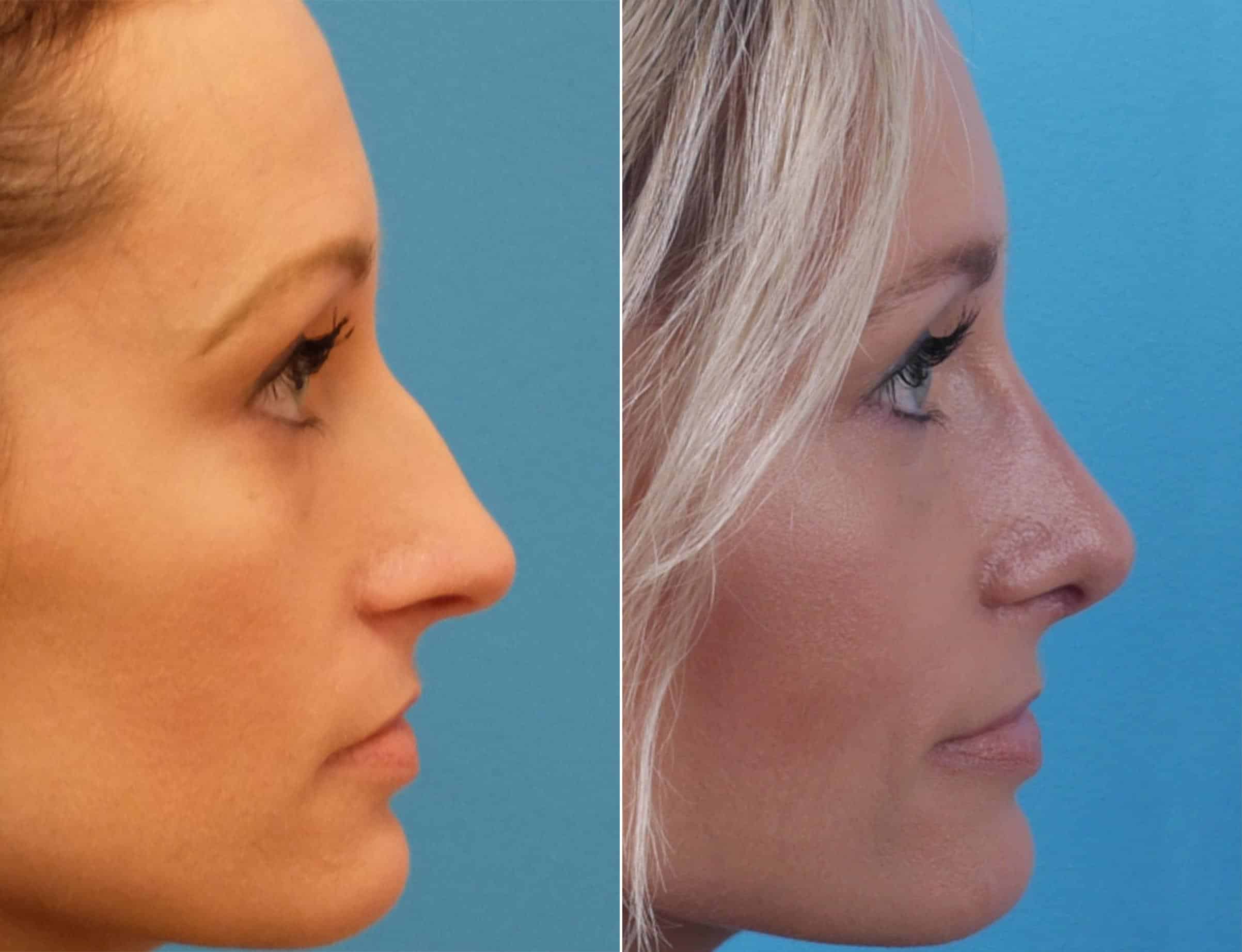 nose job before after bump