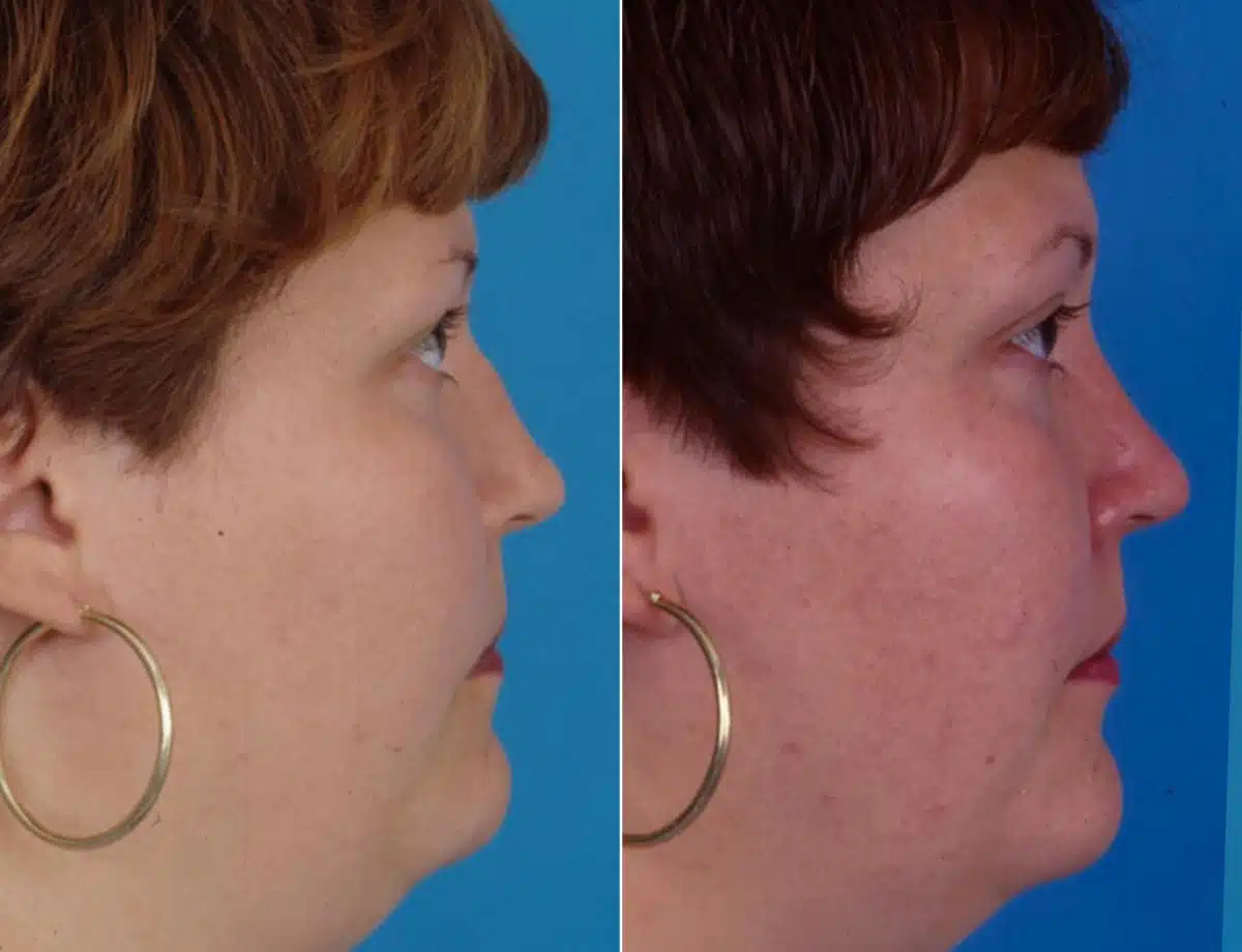 Nasal Bump Before and After Photos in Sewell, NJ, Patient 8446