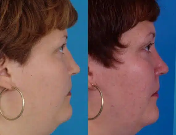 Nasal Bump Before and After Photos in Sewell, NJ