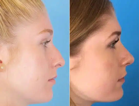 Nasal Bump Before and After Photos in Sewell, NJ, Patient 8414