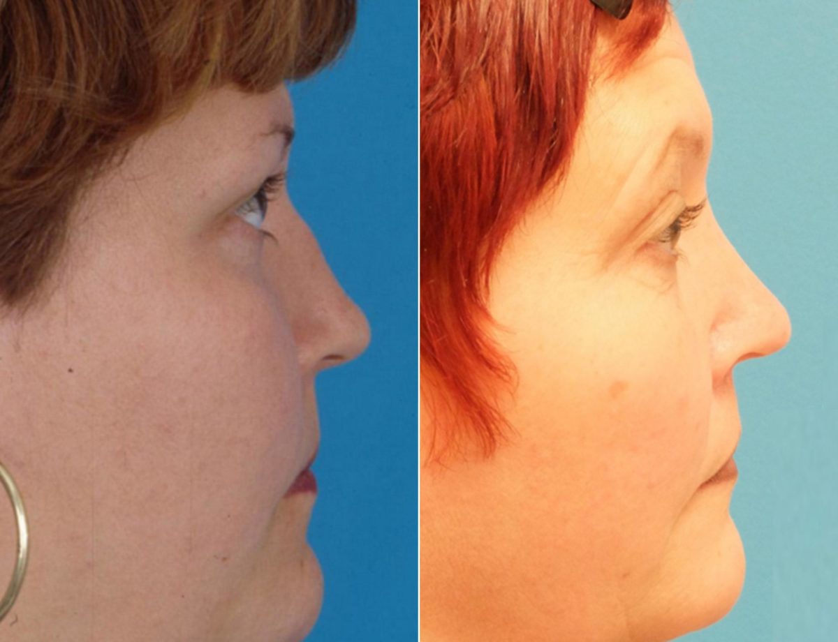 Nasal Bump Before and After Photos in Sewell, NJ, Patient 8446