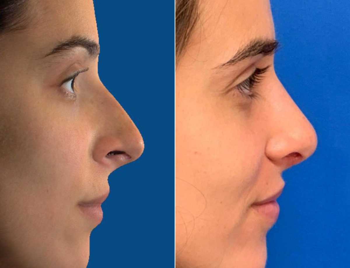 Nasal Bump Before and After Photos in Sewell, NJ, Patient 8441