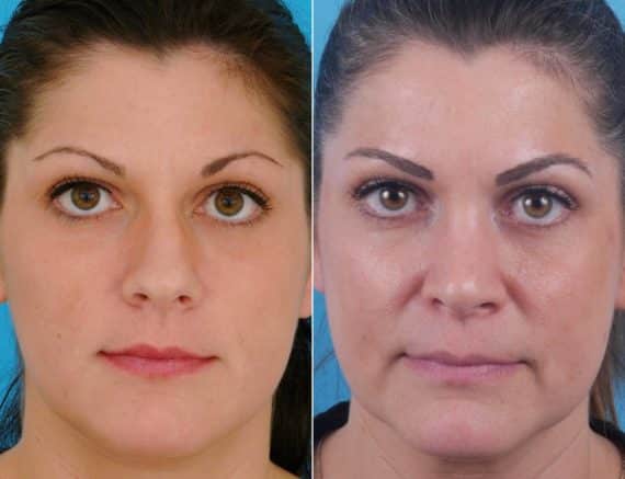 Nasal Bump Before and After Photos in Sewell, NJ, Patient 8398