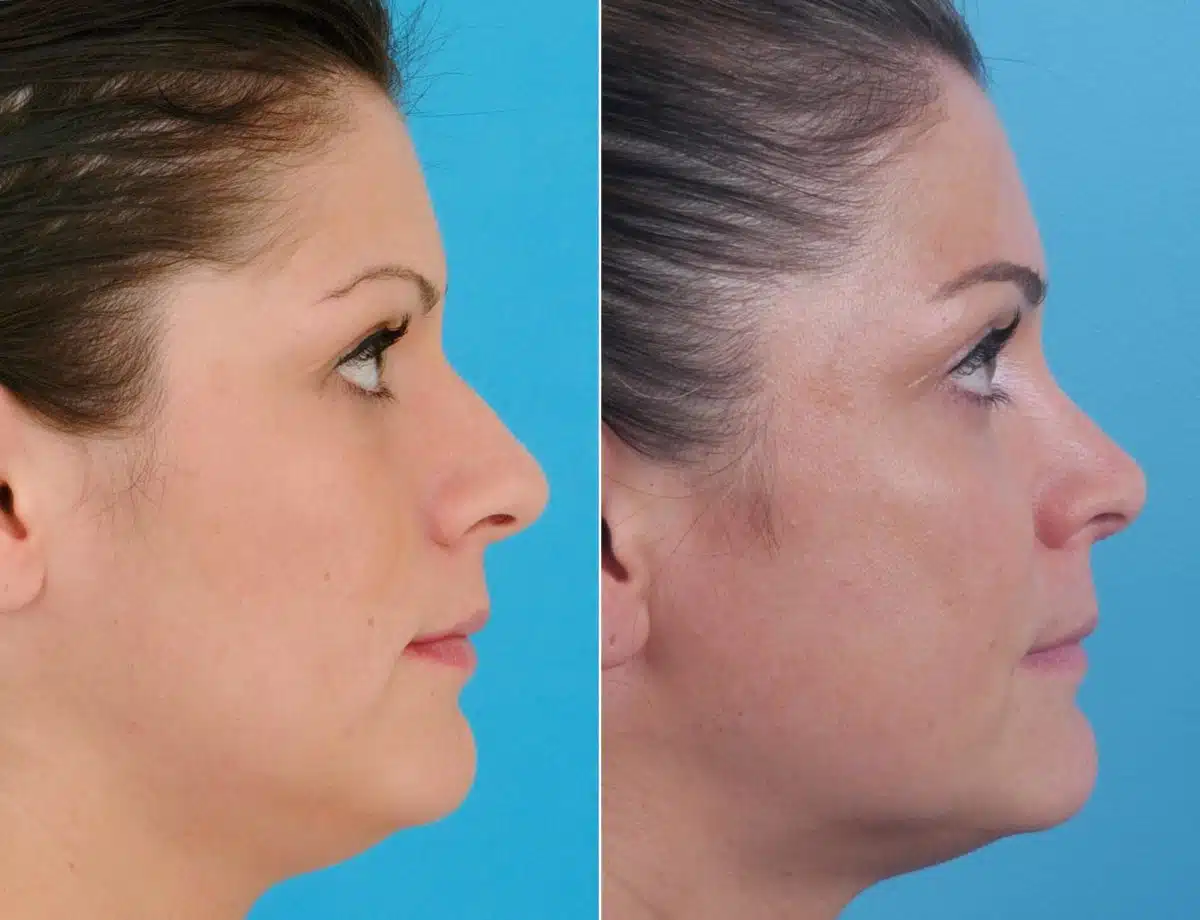 Nasal Bump Before and After Photos in Sewell, NJ, Patient 8398