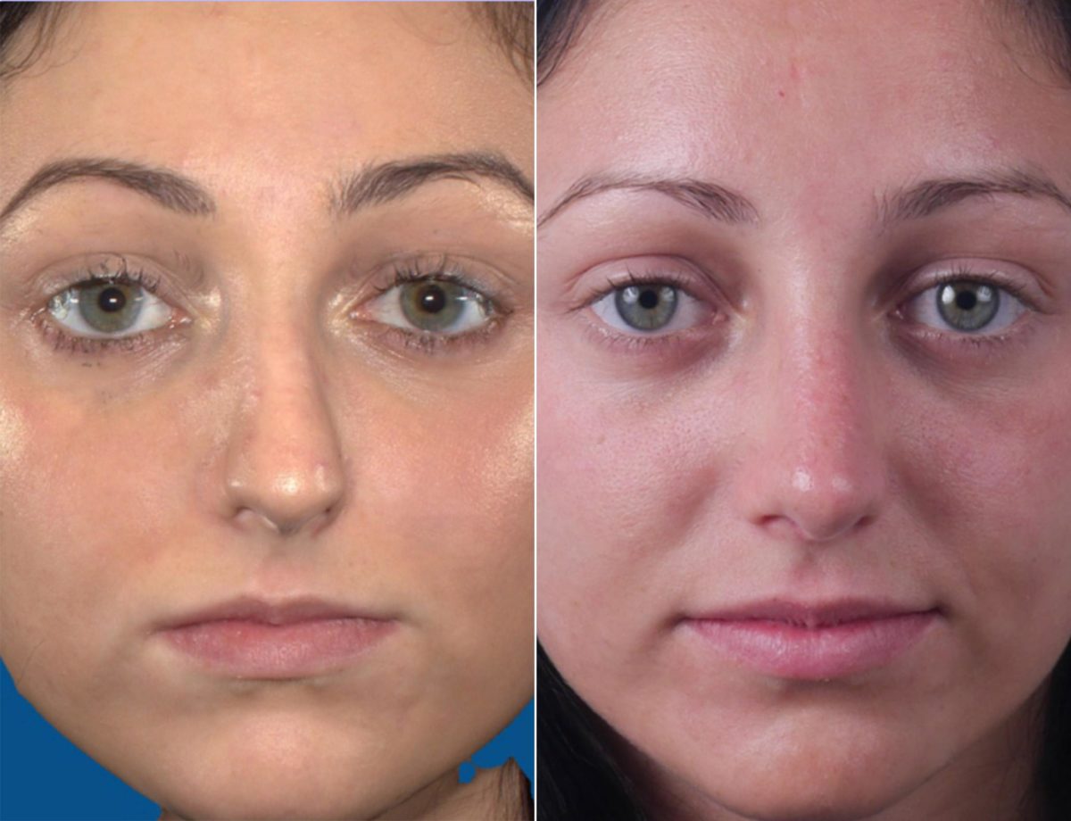 Twisted Nose Before and After Photos in Sewell, NJ, Patient 8536