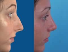 Twisted Nose Before and After Photos in Sewell, NJ, Patient 8536