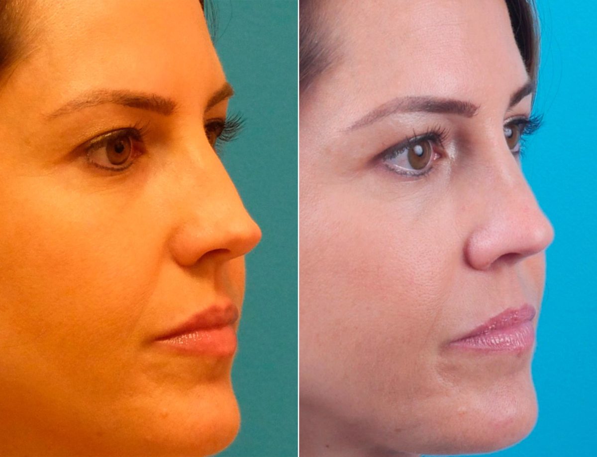 Overprojected Before and After Photos in Sewell, NJ, Patient 8594