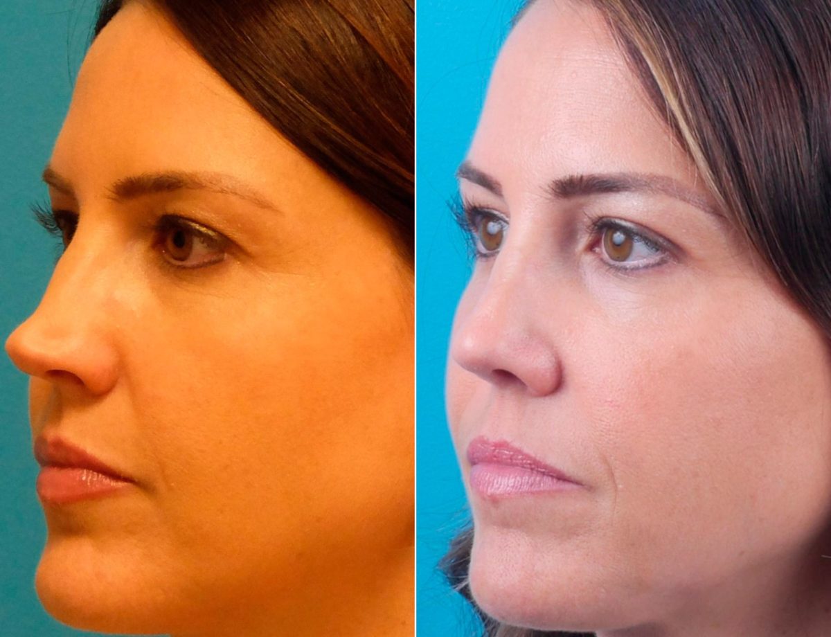 Overprojected Before and After Photos in Sewell, NJ, Patient 8594