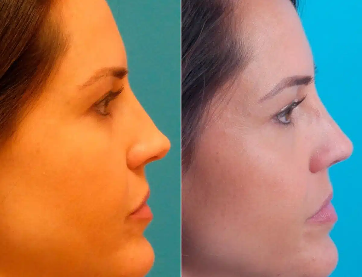 Twisted Nose Before and After Photos in Sewell, NJ, Patient 8578