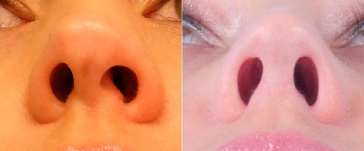 Twisted Nose Before and After Photos in Sewell, NJ, Patient 8578