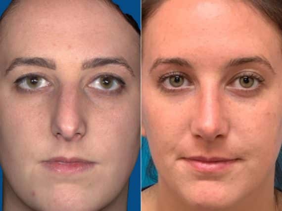 Nasal Bump Before and After Photos in Sewell, NJ, Patient 8673