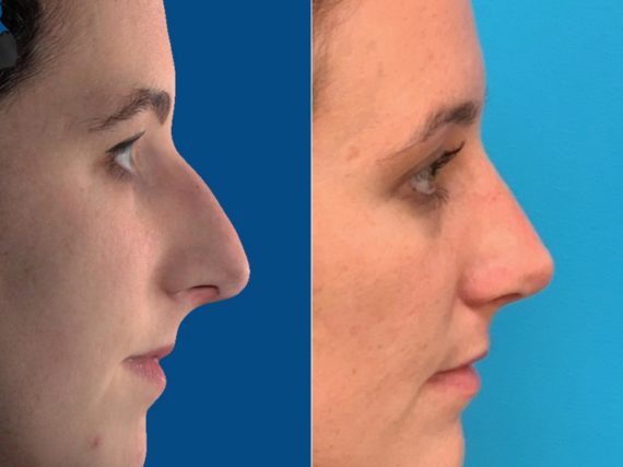 Nasal Bump Before and After Photos in Sewell, NJ, Patient 8673