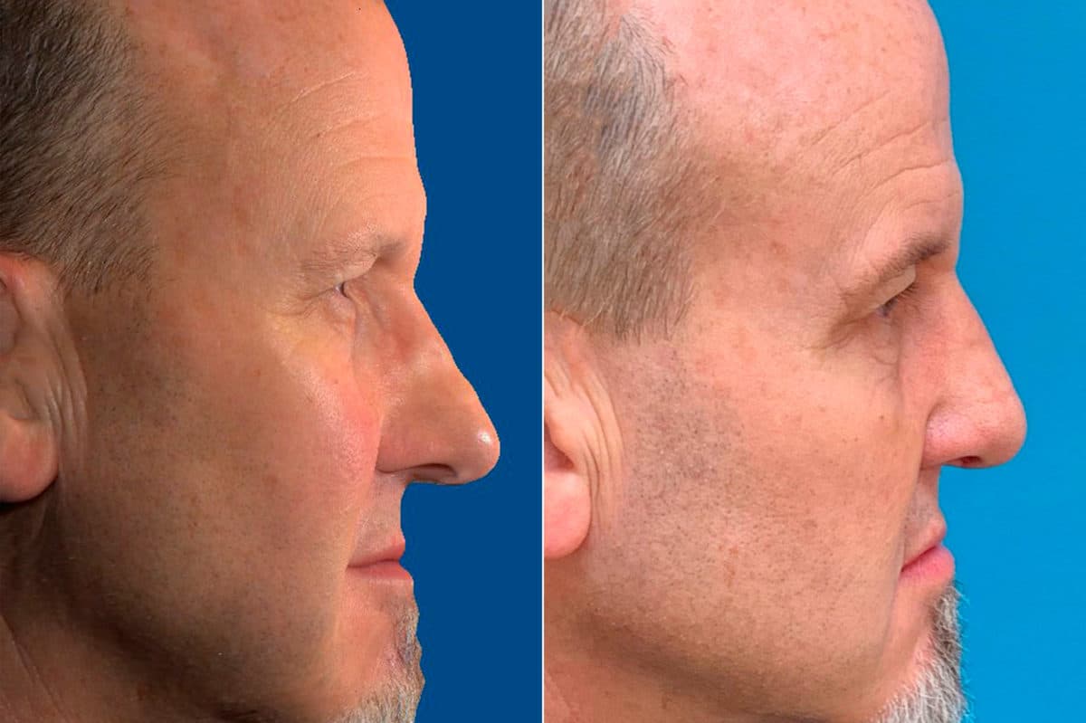 Revision Rhinoplasty Before and After Photos in Sewell, NJ, Patient 8915