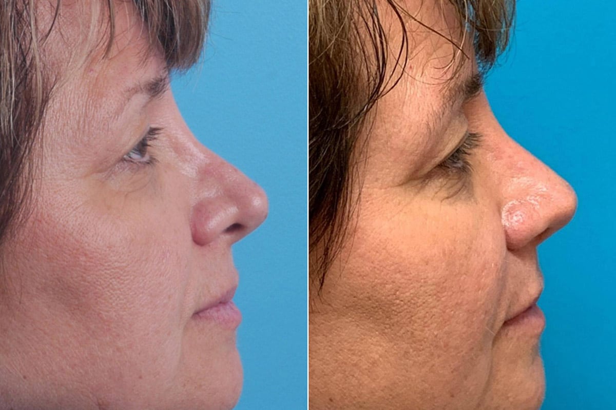Revision Rhinoplasty New Jersey Philadelphia Dr. Becker