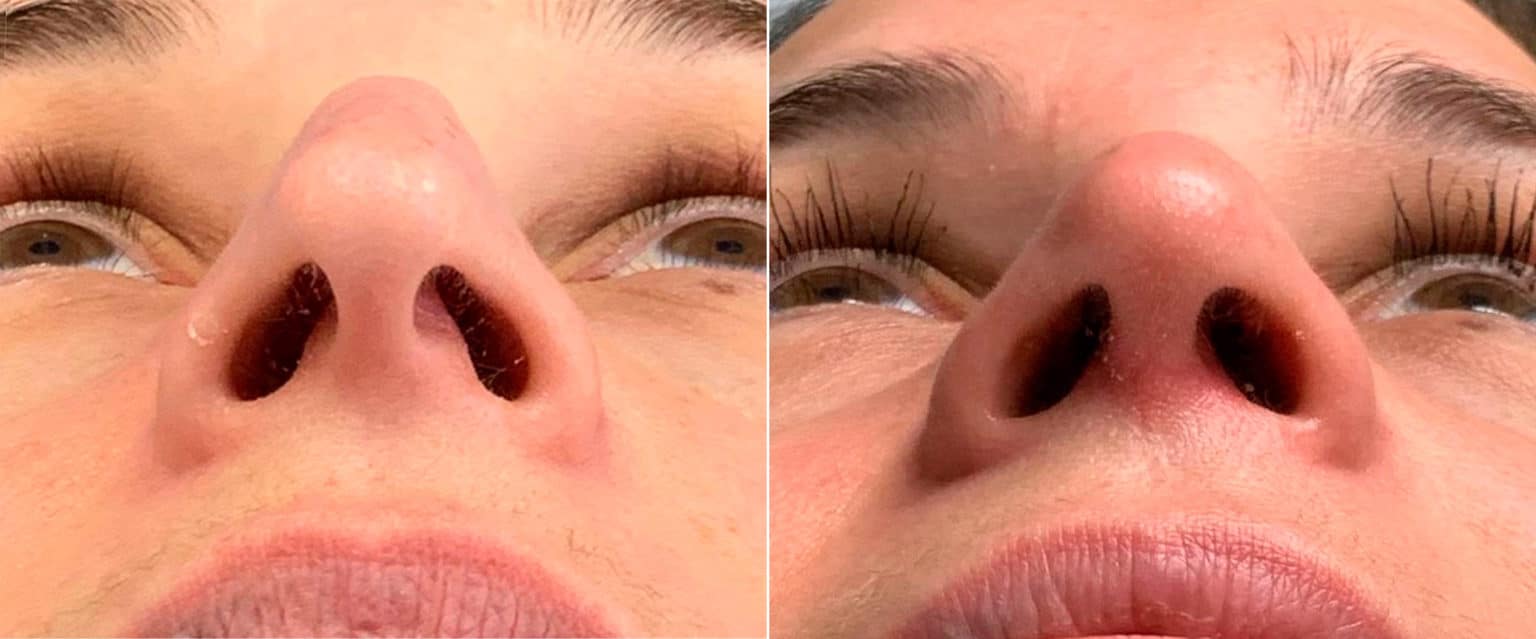 Droopy Nose Photos Princeton, NJ Patient 9094