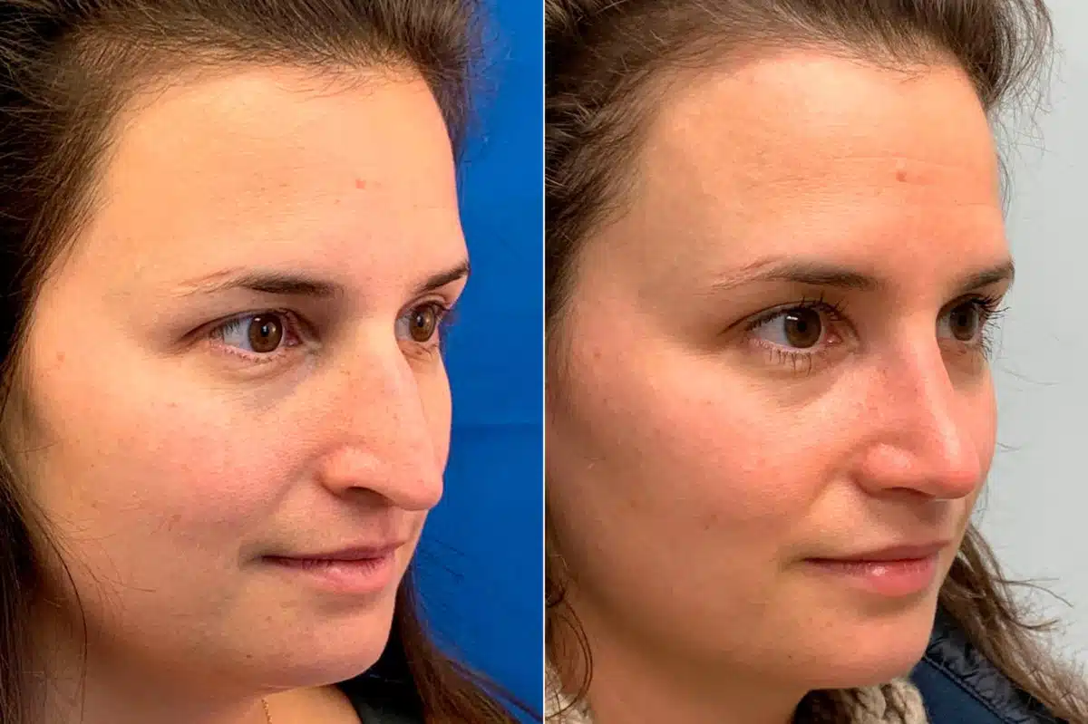 Droopy Nose Before and After Photos in Sewell, NJ, Patient 9094