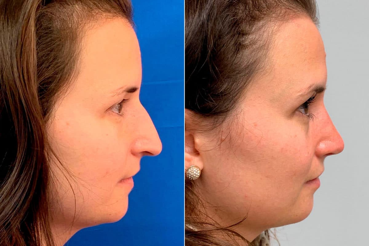 Droopy Nose Before and After Photos in Sewell, NJ, Patient 9094