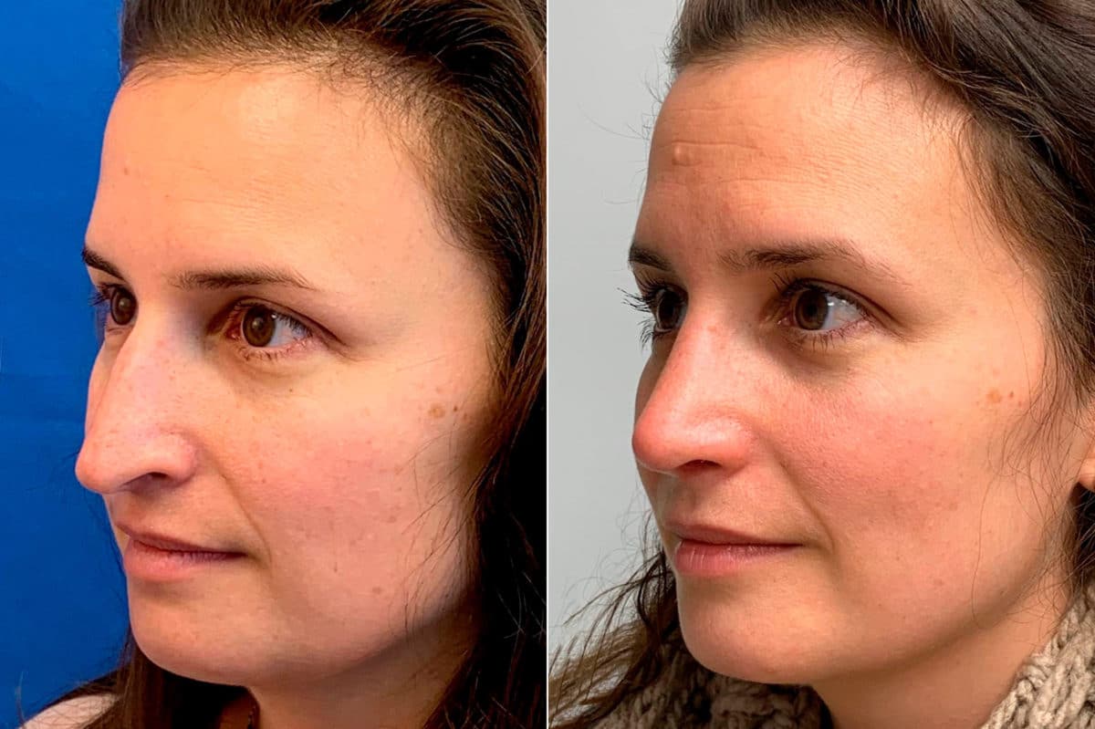 Droopy Nose Before and After Photos in Sewell, NJ, Patient 9094