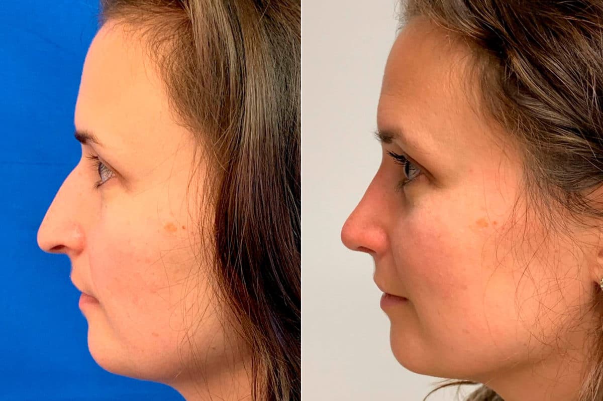 Droopy Nose Before and After Photos in Sewell, NJ, Patient 9094