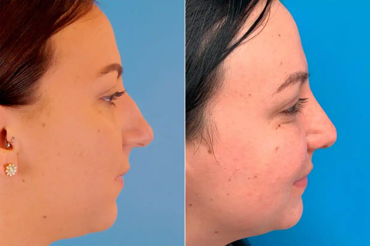 Bulbous Tip Before and After Photos in Sewell, NJ, Patient 9190