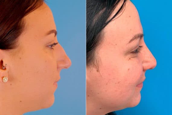 Bulbous Tip Before and After Photos in Sewell, NJ, Patient 9190