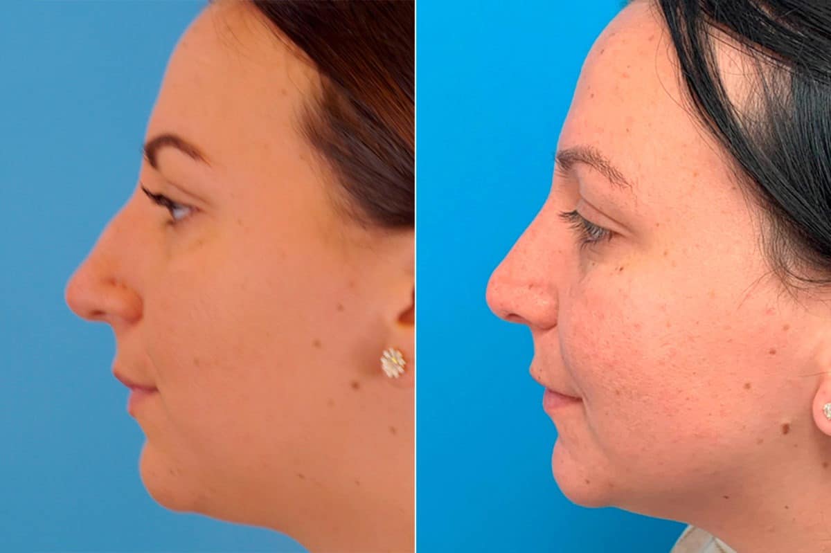 Bulbous Tip Before and After Photos in Sewell, NJ, Patient 9190