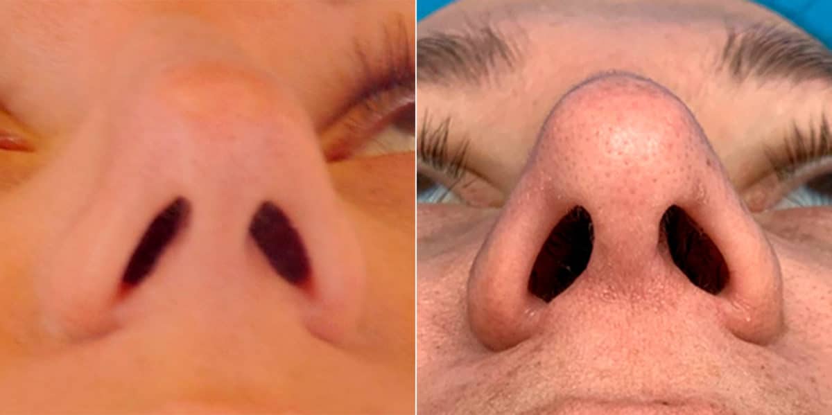 Bulbous Tip Before and After Photos in Sewell, NJ, Patient 9190