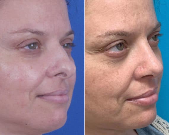 Bulbous Tip Before and After Photos in Sewell, NJ, Patient 8440