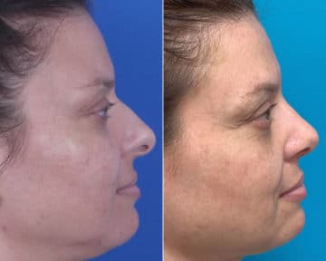 Bulbous Tip Before and After Photos in Sewell, NJ, Patient 8440