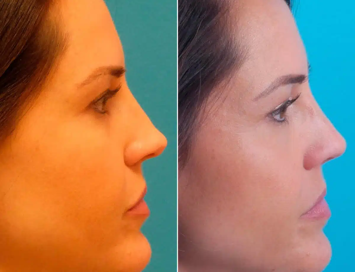 Overprojected Before and After Photos in Sewell, NJ, Patient 8594