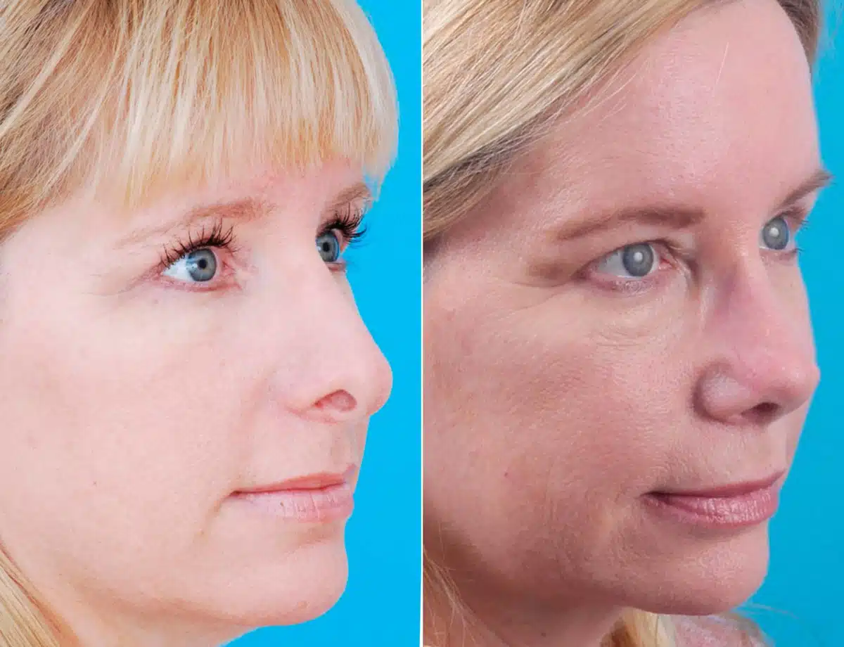 Revision Rhinoplasty Before and After Photos in Sewell, NJ, Patient 8602