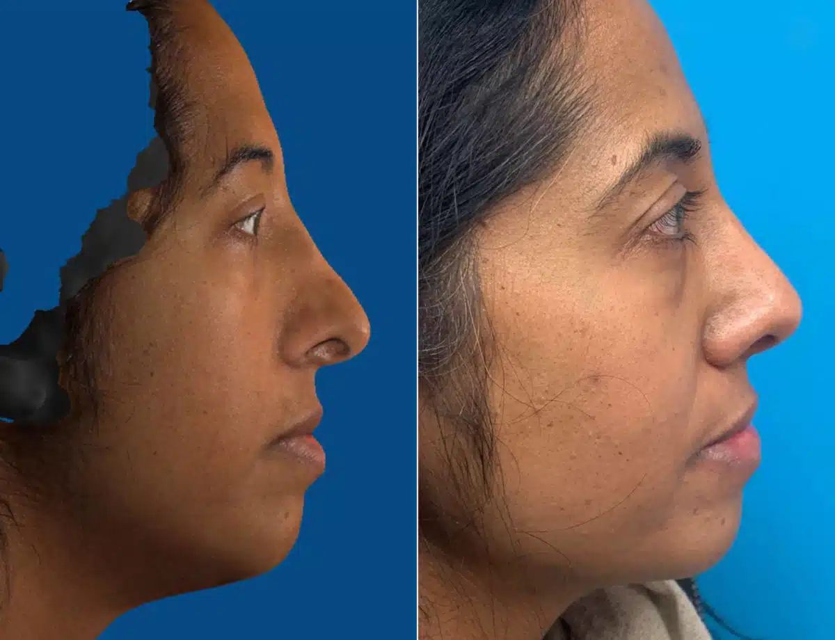 Revision Rhinoplasty Before and After Photos in Sewell, NJ, Patient 9371