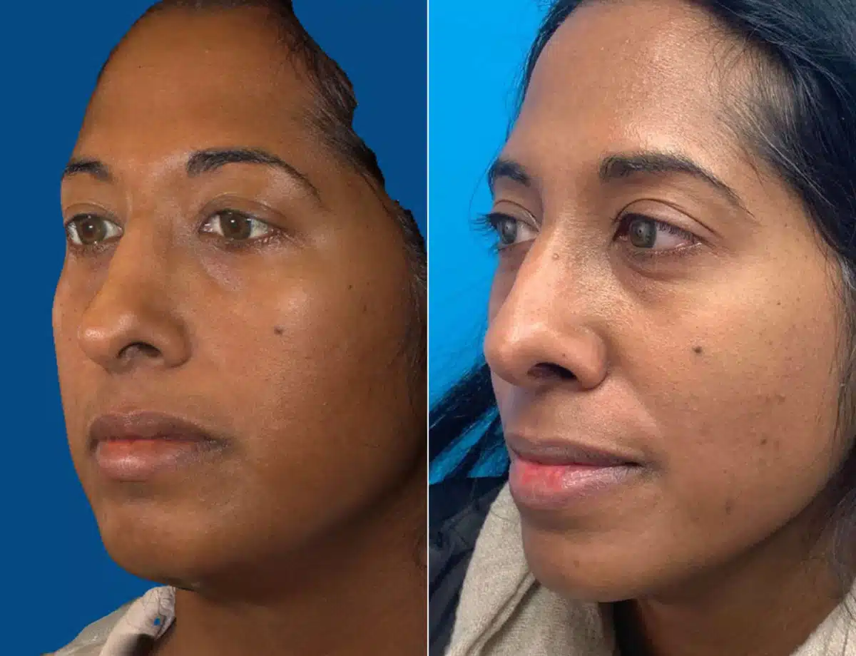 Revision Rhinoplasty Before and After Photos in Sewell, NJ, Patient 9371