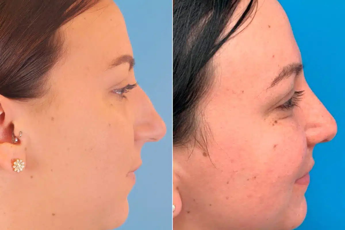 Droopy Nose Before and After Photos in Sewell, NJ, Patient 9377