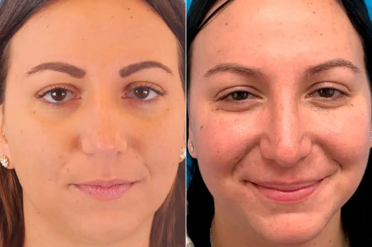 Droopy Nose Before and After Photos in Sewell, NJ, Patient 9377