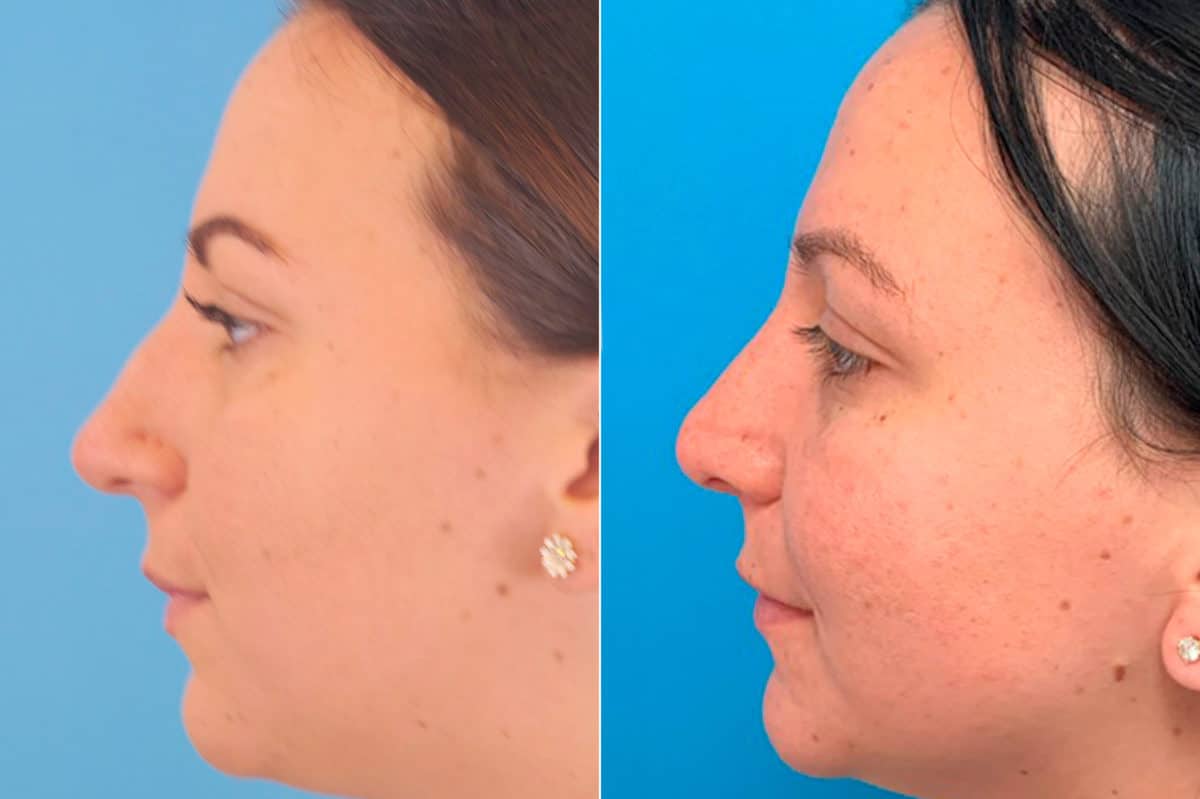 Droopy Nose Before and After Photos in Sewell, NJ, Patient 9377